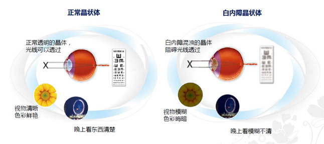 白內障和老花眼區別