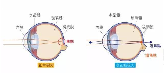 白內障和老花眼區別，老花眼發(fā)病率正呈現年輕化趨勢