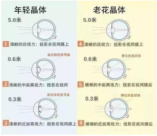 近視就不會(huì )老花了嗎？